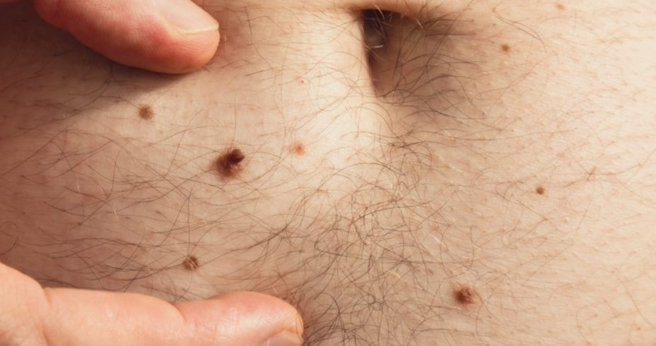 Skin tag removal treatment